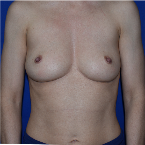 Front view after breast implant removal