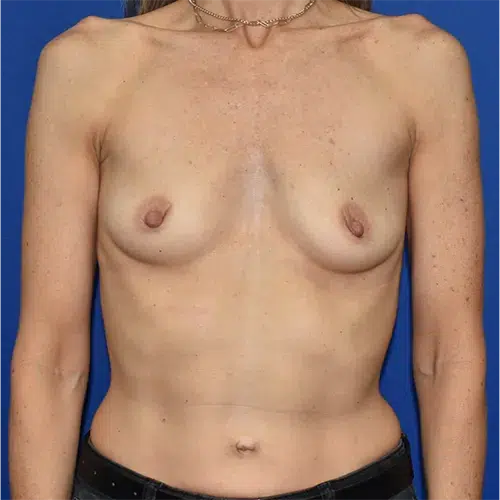 Patient 19, front view before breast augmentation