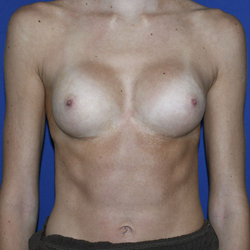 Patient 01, front view after mini breast augmentation