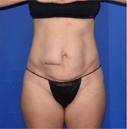 Patient 07, view 1 view before tummy tuck