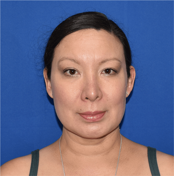 Patient 14, view 1 view after chin liposuction
