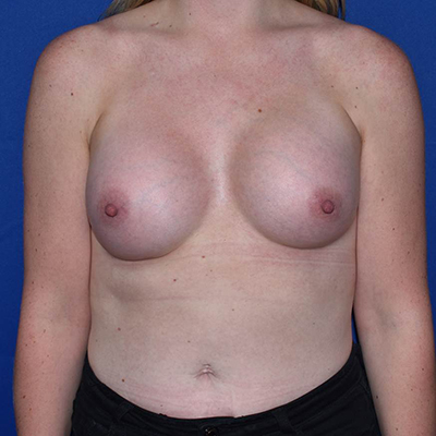 Patient 119, view 1 view after breast augmentation