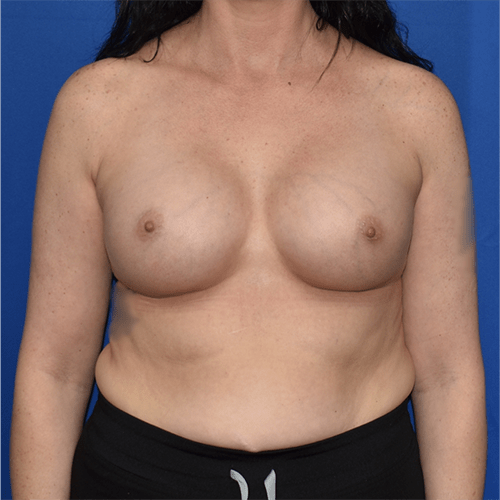 Patient 126, view 1 view after breast augmentation
