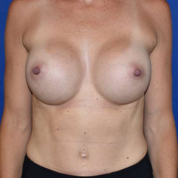 Patient 25, view 1 view before breast implant revision
