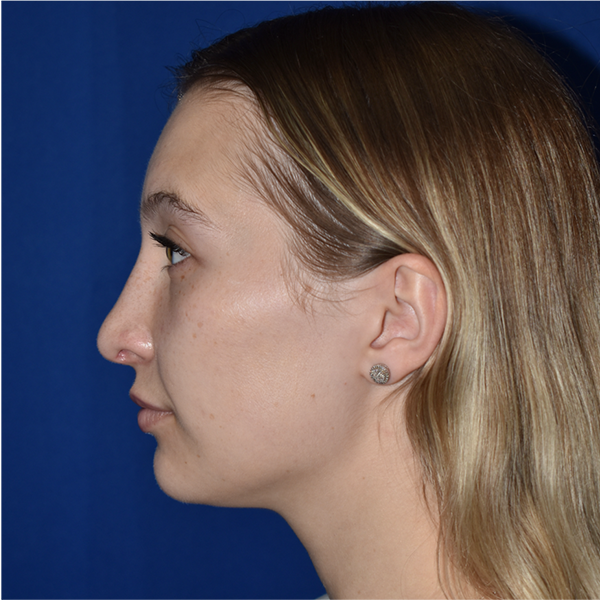 Patient 06, view 1 view after rhinoplasty