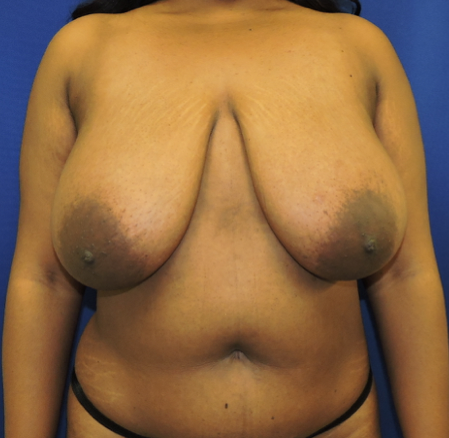 Patient 19, view 1 view before breast lift