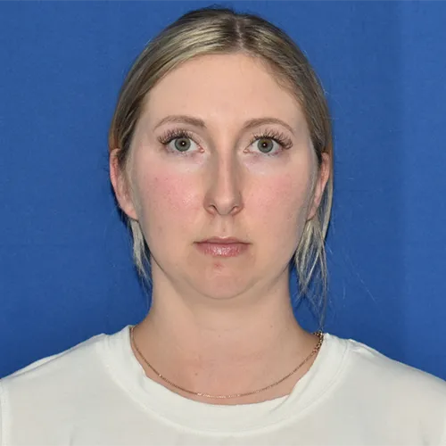 Patient 05, front view before chin augmentation