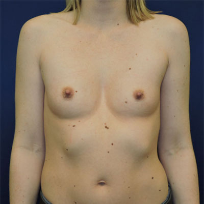 Patient 114, view 1 view before breast augmentation