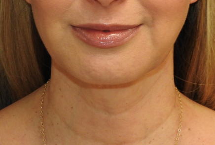 Patient 04, view 1 view before chin augmentation