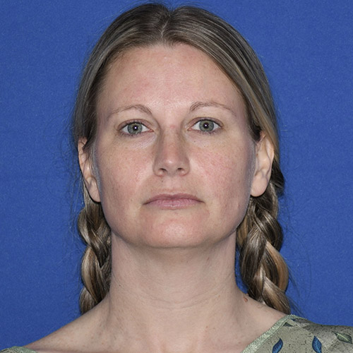 Patient 08, front view before chin liposuction