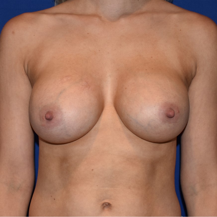 Patient 54, view 1 view after breast augmentation