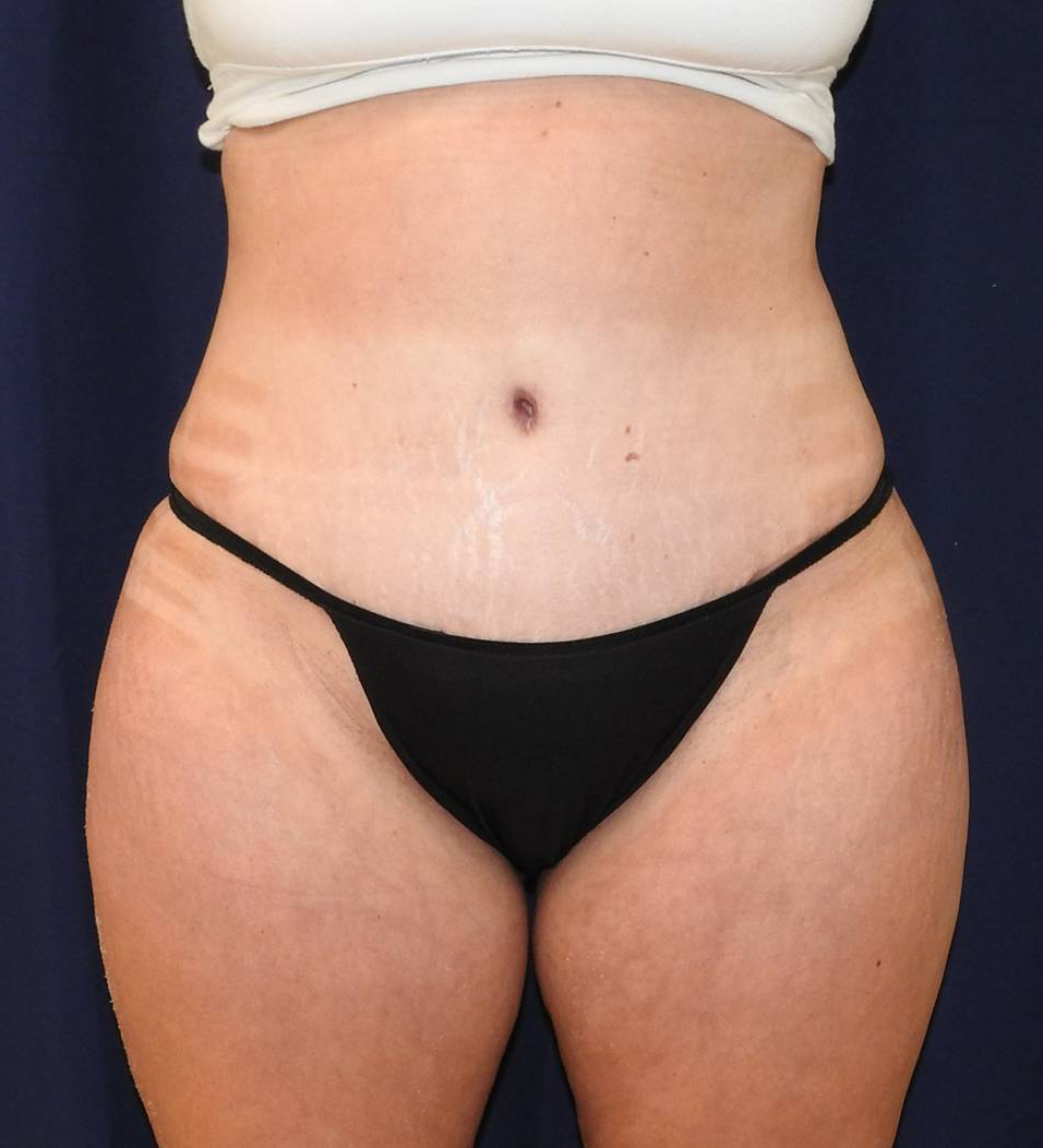 Selected view after tummy tuck