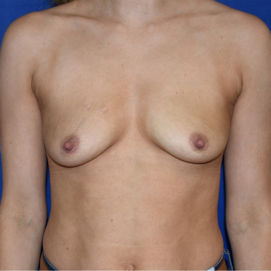 Patient 54, view 1 view before breast augmentation