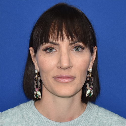Patient 16, view 1 view before rhinoplasty