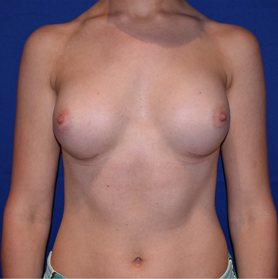 Patient 106, view 1 view after breast augmentation