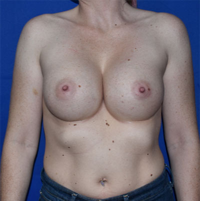 Patient 114, view 1 view after breast augmentation