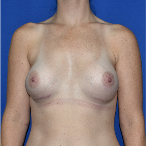 Patient 13, view 1 view after breast implant revision