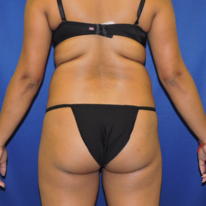 Patient 11, view 1 view before brazilian butt lift