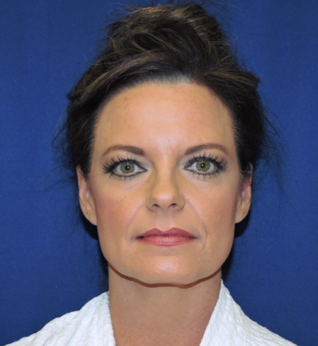 Patient 09, view 1 view before facial fat grafting