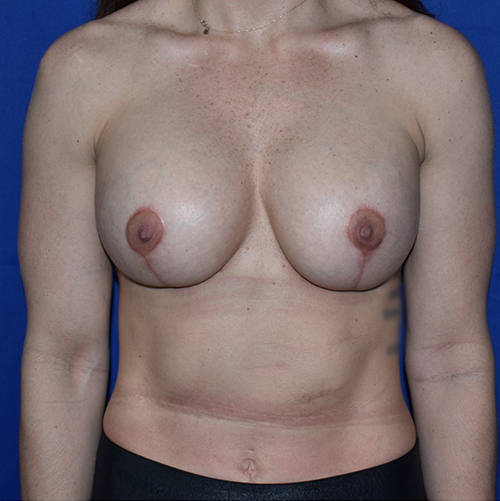 Patient 16, view 1 view after breast augmentation with lift