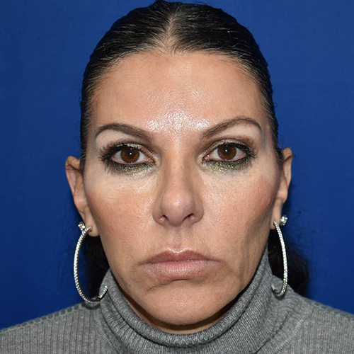 Patient 01, view 1 view before lip augmentation/lip implant