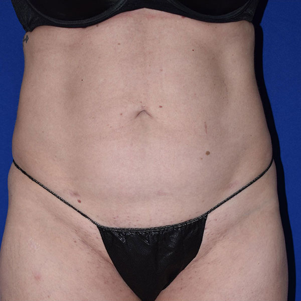 Patient 18, view 1 view after liposuction