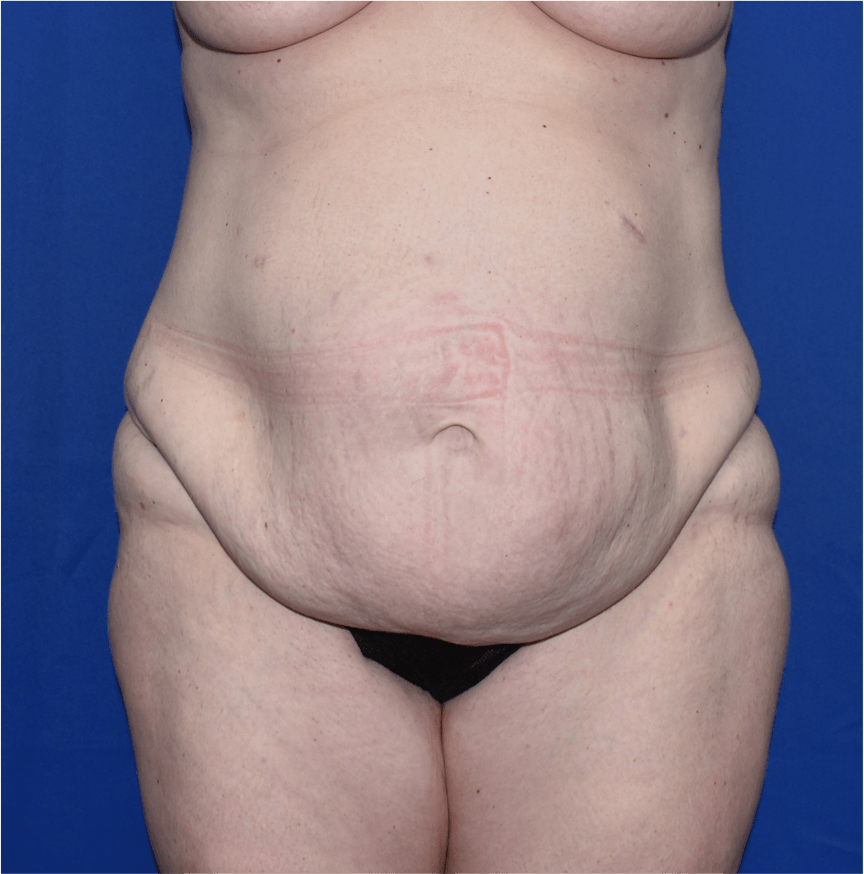 Patient 16, view 1 view before tummy tuck