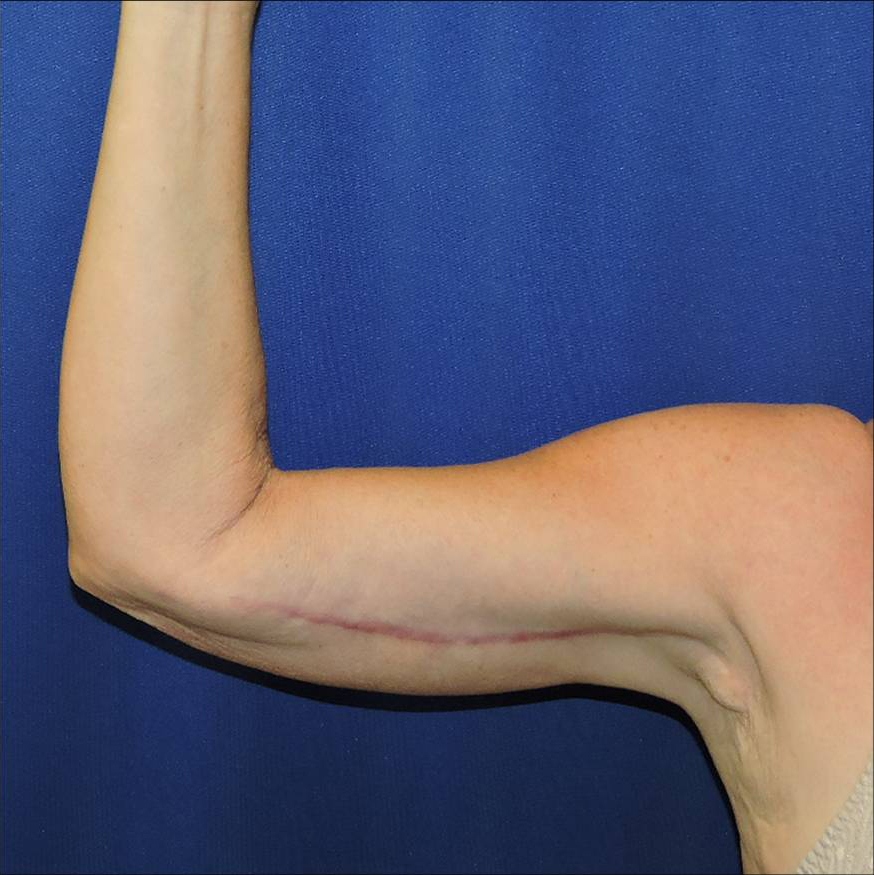 Patient 05, view 1 view after arm lift