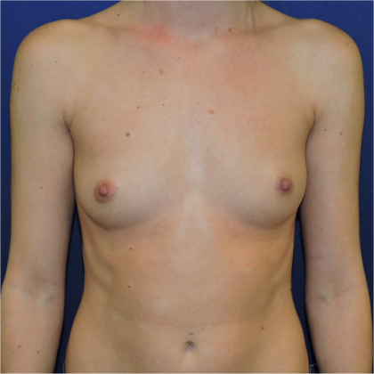 Patient 09, view 1 view before mini breast augmentation