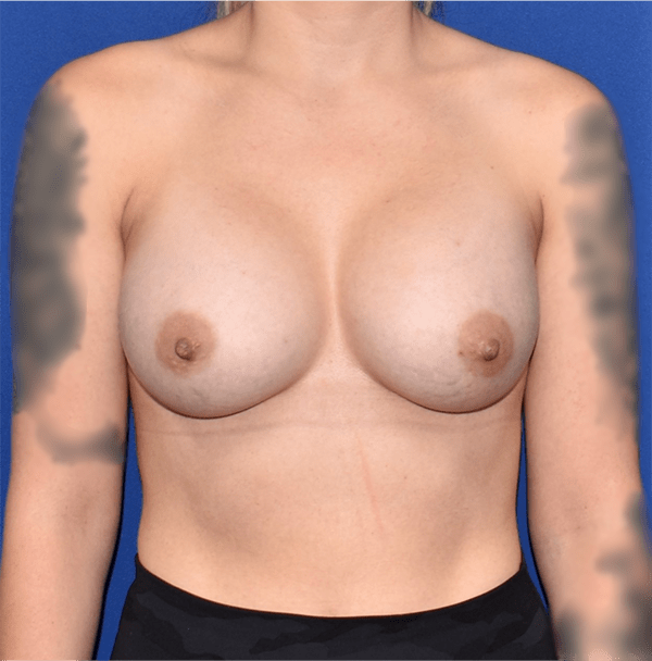 Patient 05, view 1 view after breast augmentation