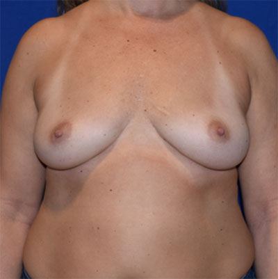 Patient 115, view 1 view before breast augmentation
