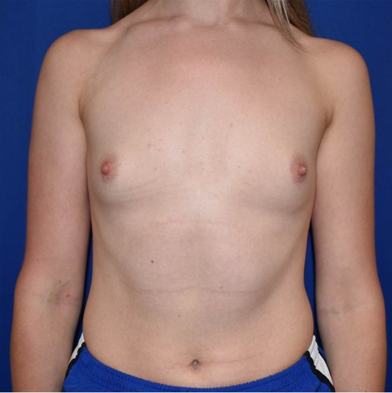 Patient 106, view 1 view before breast augmentation