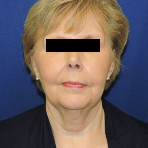 Patient 06, view 1 view before neck lift