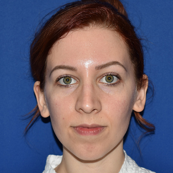 Patient 07, view 1 view before chin augmentation