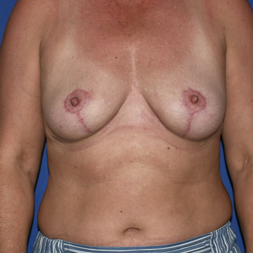 Patient 16, front view after implant removal