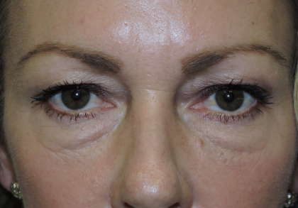 Patient 16, view 1 view before blepharoplasty
