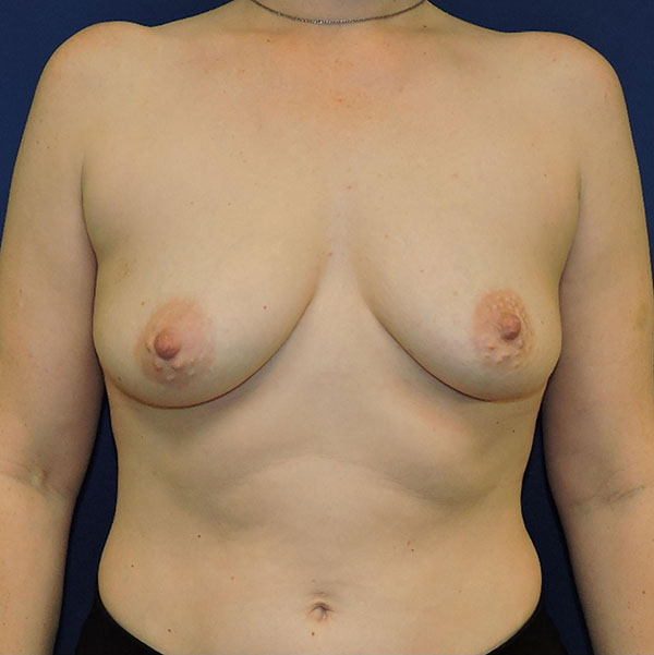Patient 100, view 1 view before breast augmentation