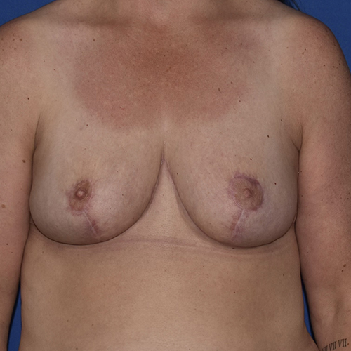 Patient 10, front view after breast reduction