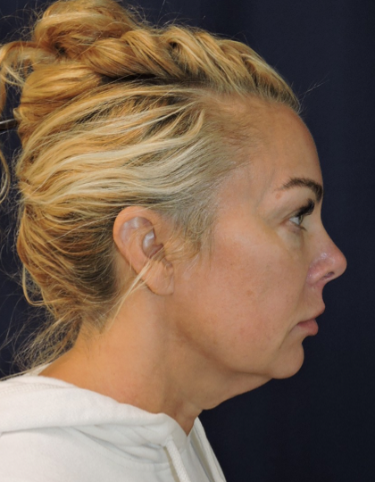 View 3 before neck lift