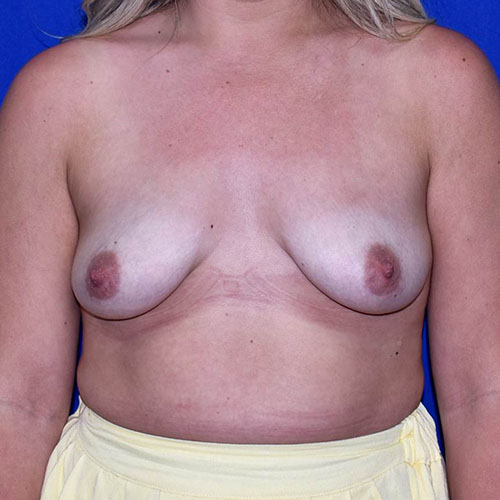 Patient 124, view 1 view before breast augmentation