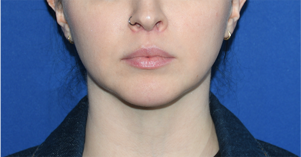 Patient 01, front view after lip lift