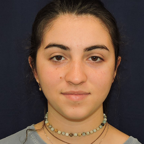 Patient 15, view 1 view before rhinoplasty