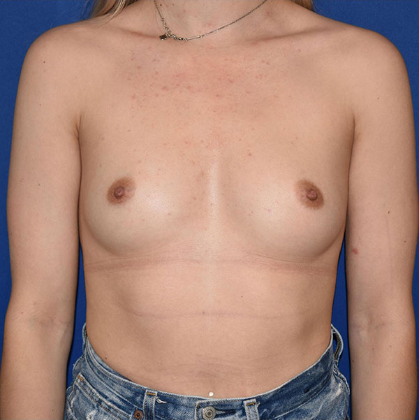 Patient 89, view 1 view before breast augmentation