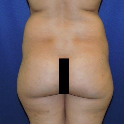 Patient 02, view 1 view before brazilian butt lift