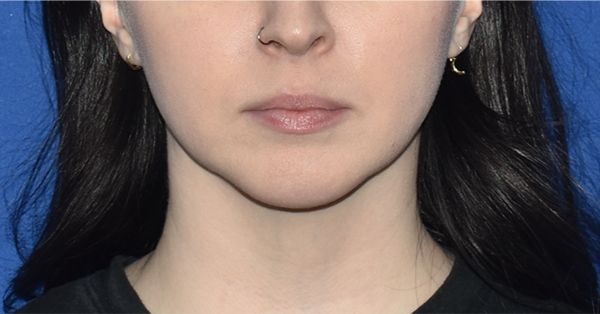 Patient 01, front view before lip lift