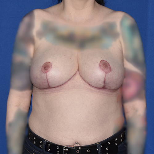 Patient 12, front view after breast reduction