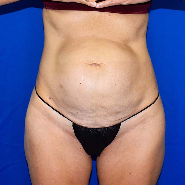 Patient 21, view 1 view before tummy tuck