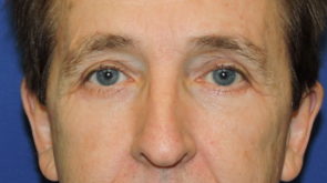 Patient 14, view 1 view after blepharoplasty