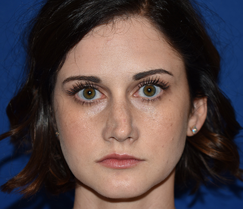 Front view before revision rhinoplasty