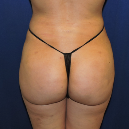 Patient 02, view 1 view after brazilian butt lift